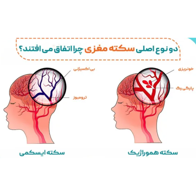 سکته مغزی CVA