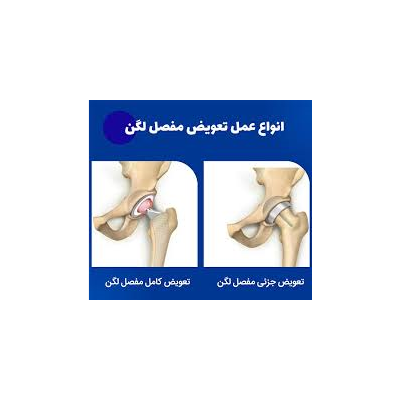 تعویض مفصل ران یا لگن (آرتروپلاستی)