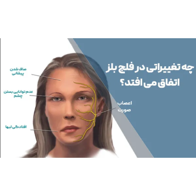 فلج بلز Bells Palsy