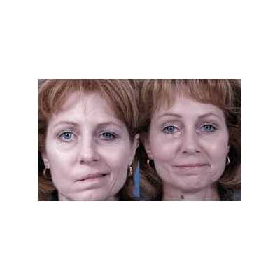 فلج بلز Bells Palsy