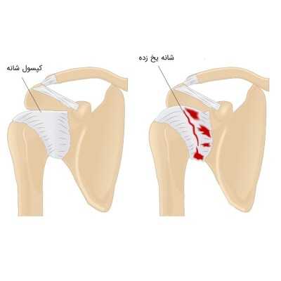 شانه یخ زده Frozen Shoulder
