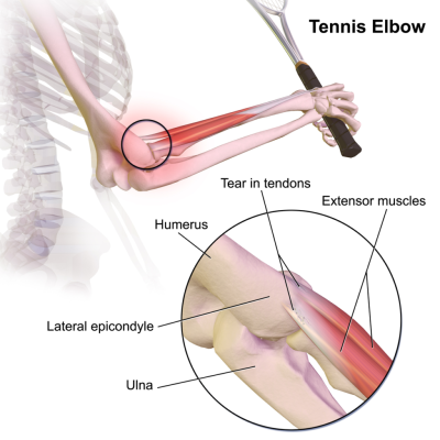 آرنج تنیس بازان Tennis Elbow