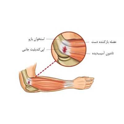 آرنج تنیس بازان Tennis Elbow