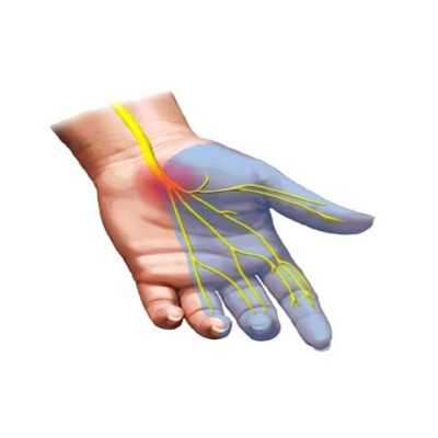 سندرم تونل کارپال CTS