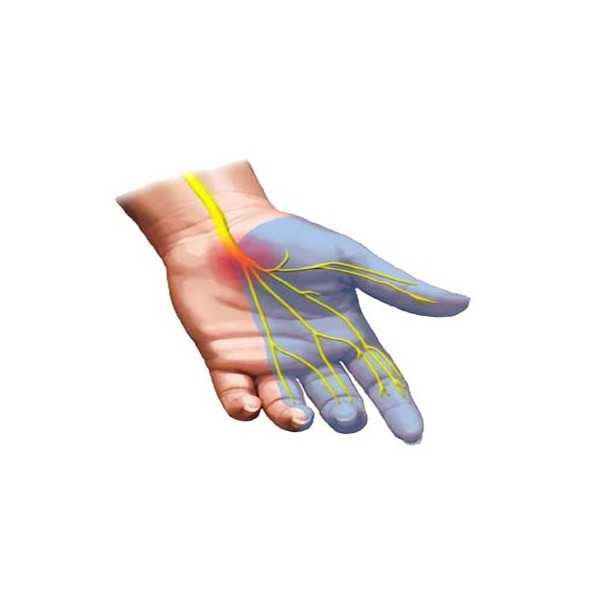سندرم تونل کارپال CTS