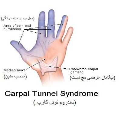 سندرم تونل کارپال CTS