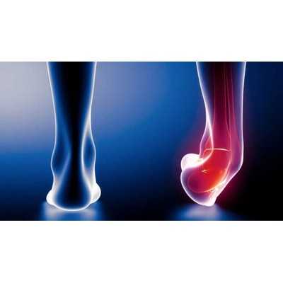 پیچ خوردگی مچ پا  Ankle Sprain