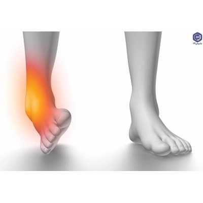 پیچ خوردگی مچ پا  Ankle Sprain