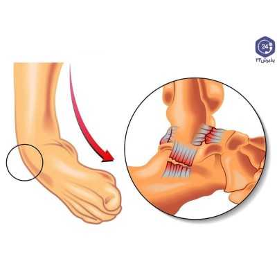 پیچ خوردگی مچ پا  Ankle Sprain